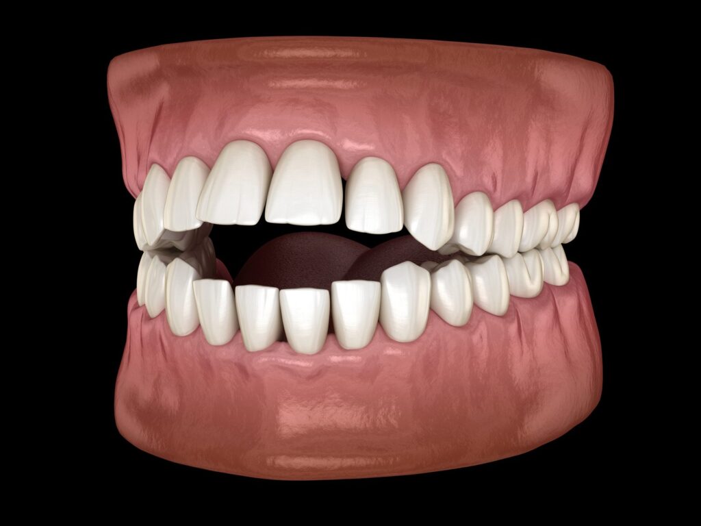 3D illustration of an anterior open bite where the front teeth do not meet